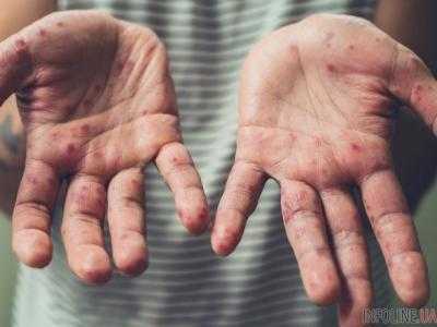 С начала года корью заболели около 24 тыс. украинцев