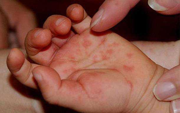 Опасный вирус в Украине.Врачи бьют тревогу