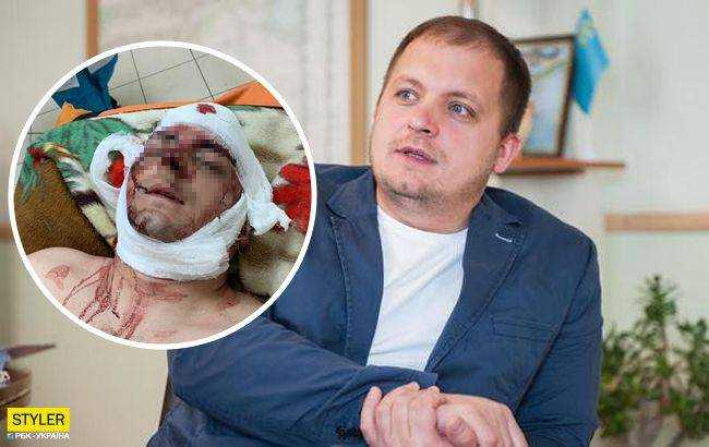 Жестокое избиение экс-мэра Конотопа: пострадавший назвал заказчика нападения